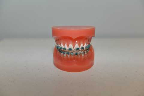 Photo of metal braces on a teeth model